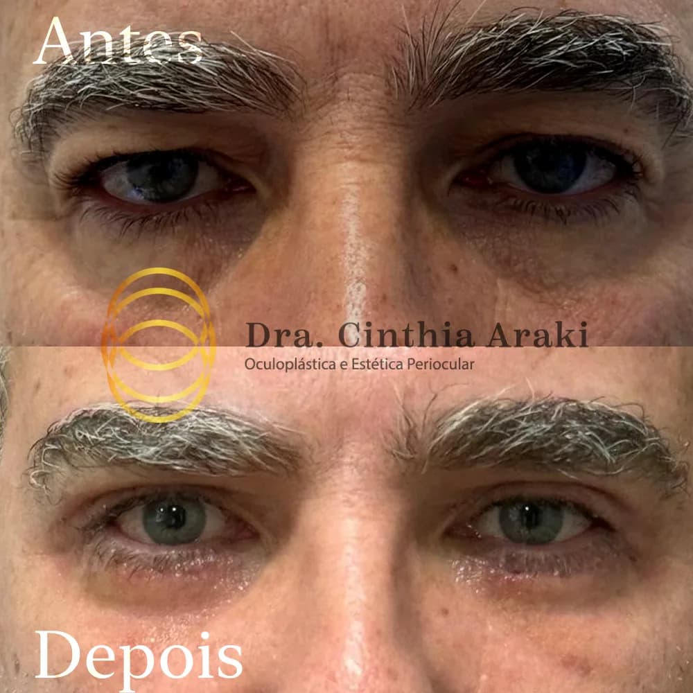 Antes e depois 2