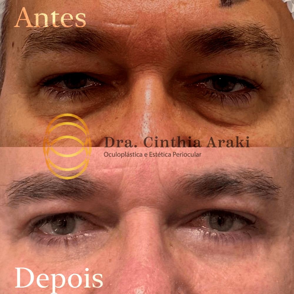 Antes e depois 6