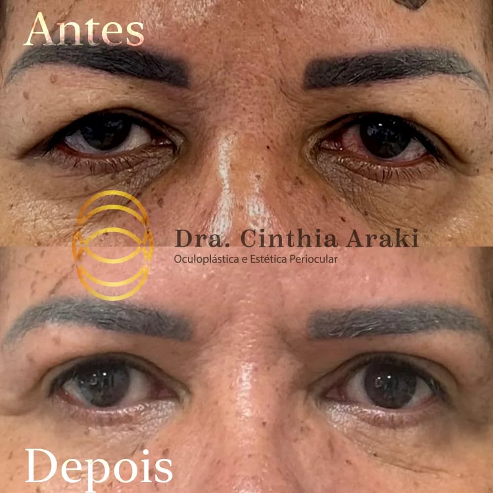 Antes e depois 11