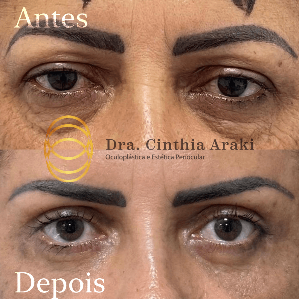Antes e depois 13