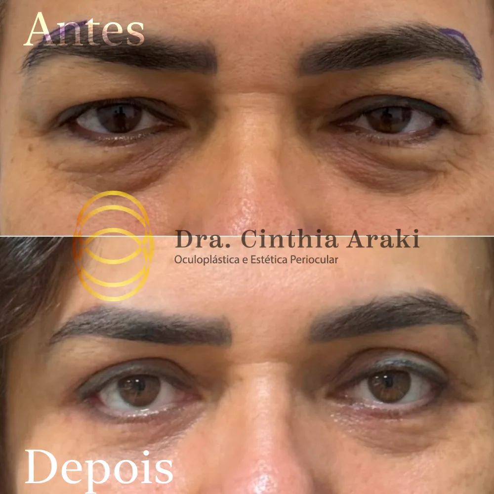 Antes e depois 14