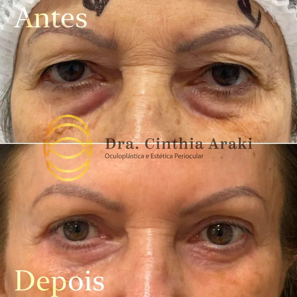 Antes e depois 15